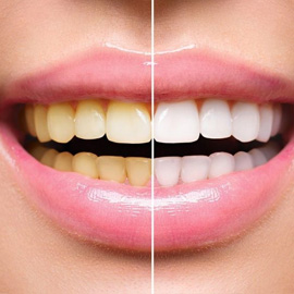 Teeth Whitening