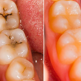 Tooth Colored Fillings
